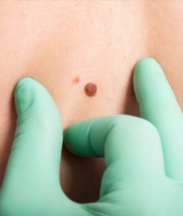 Types of skin moles and how to know if they’re safe