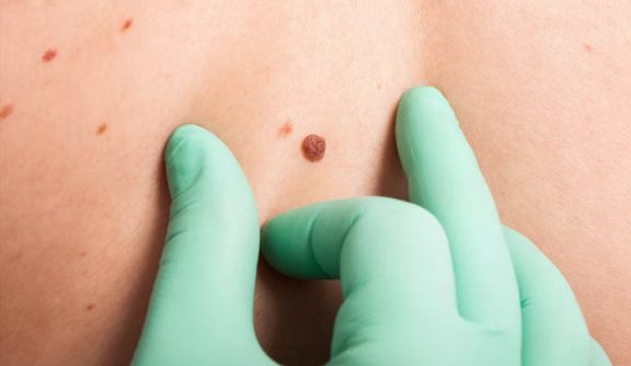 Types of skin moles and how to know if they’re safe