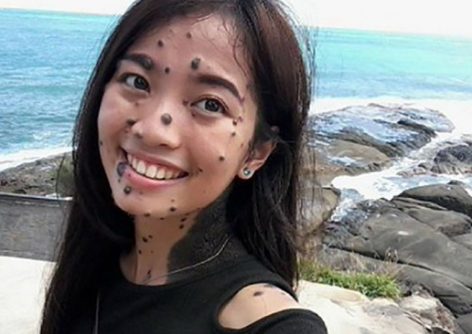 Woman Born With Moles All Over Her Body Is Trying Out for Miss Universe
