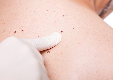 Skin Cancer Self-examinations: Understand Your Risks