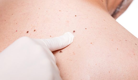 Skin Cancer Self-examinations: Understand Your Risks