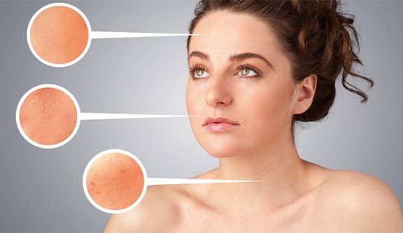 What Type of Acne Do You Have? Types of Acne Explained