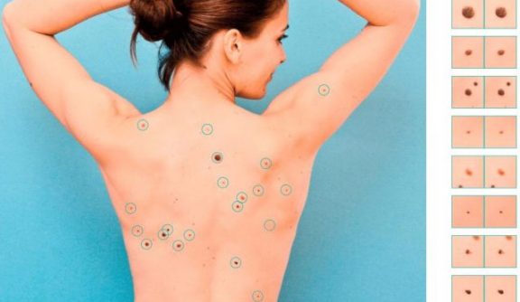 Mole mapping – what is it and how to get your moles mapped?