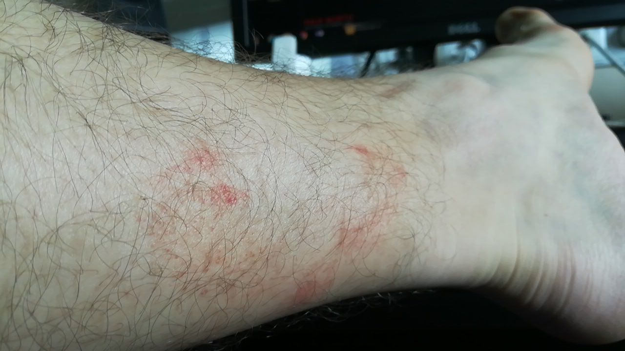 Eczema (ICD10 L20L30) Online consultation AI dermatologist