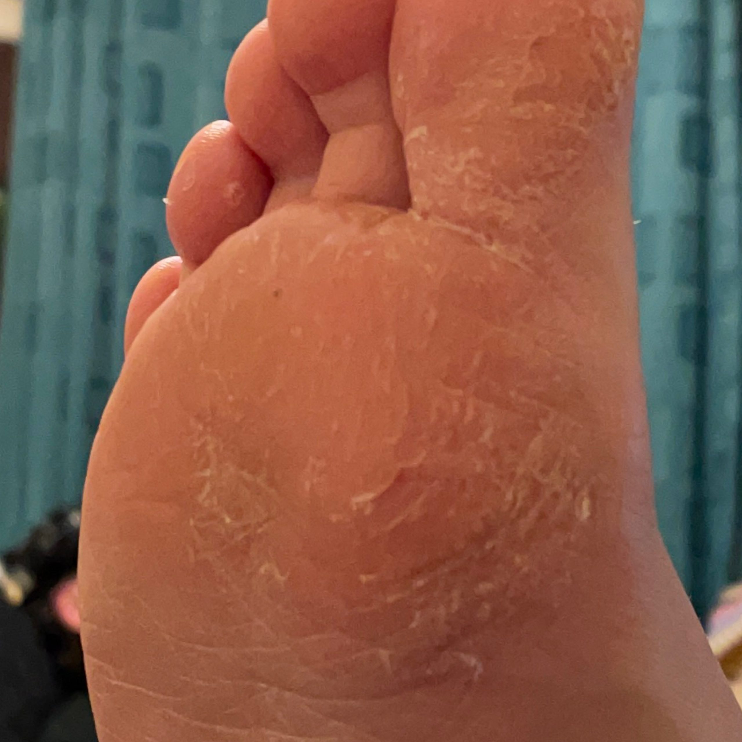 Eczema (ICD10 L20L30) Online consultation AI dermatologist