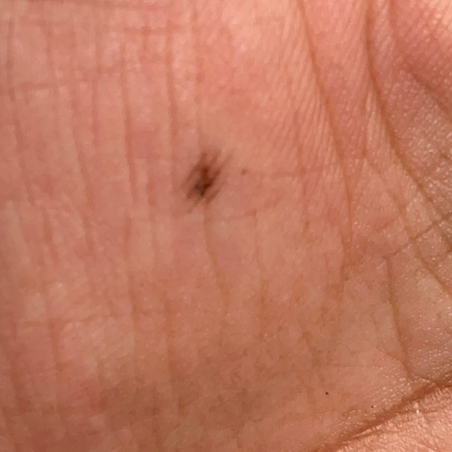 Acral Nevus (ICD 10: D22) Skinive AI