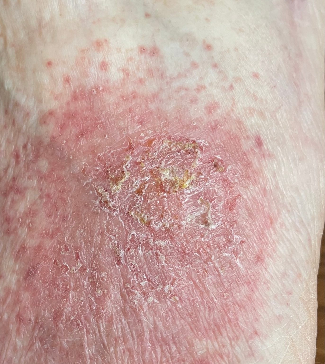 Eczema (ICD10 L20L30) Online consultation AI dermatologist