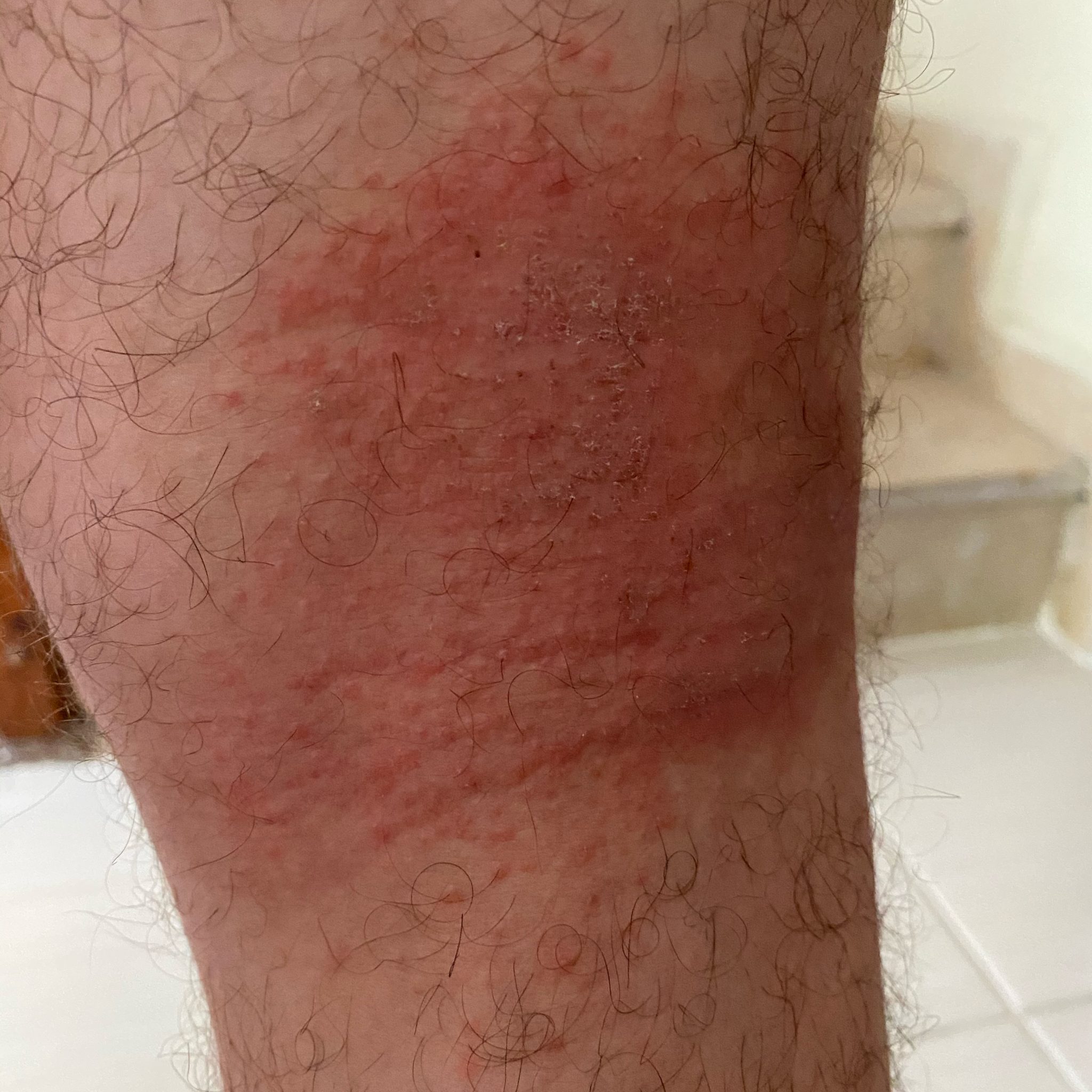 Atopic Dermatitis (ICD10 L20) Online consultation AI dermatologist