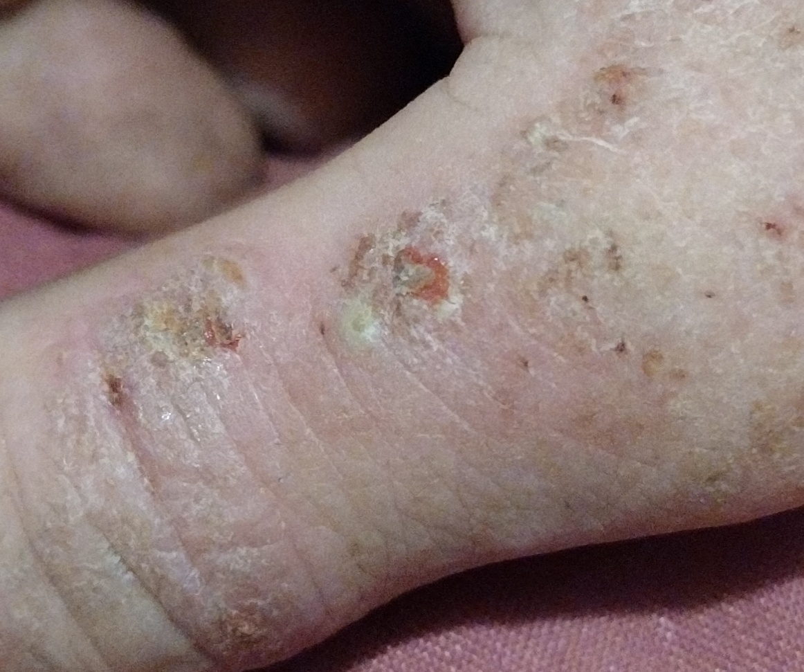 Eczema (ICD10 L20L30) Online consultation AI dermatologist