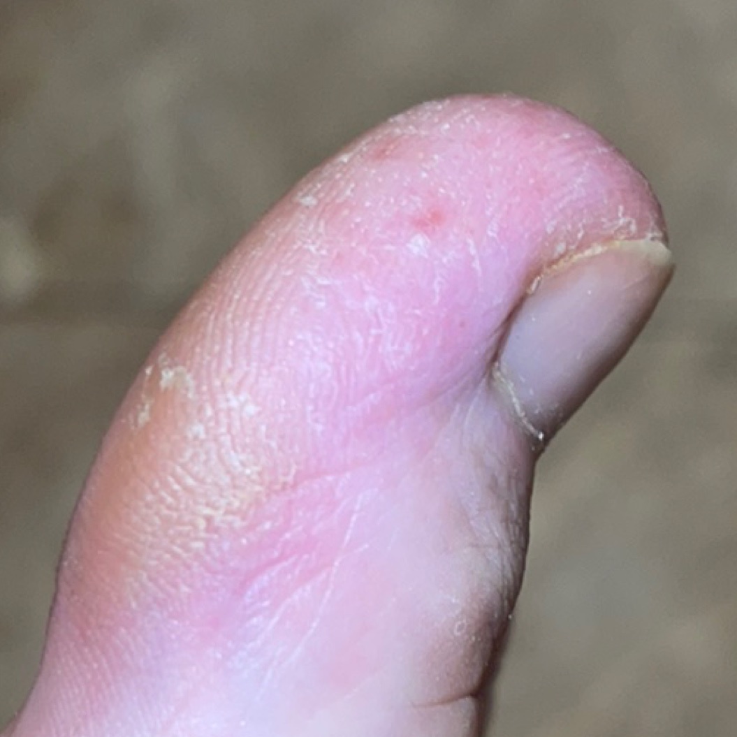 Eczema (ICD10 L20L30) Online consultation AI dermatologist