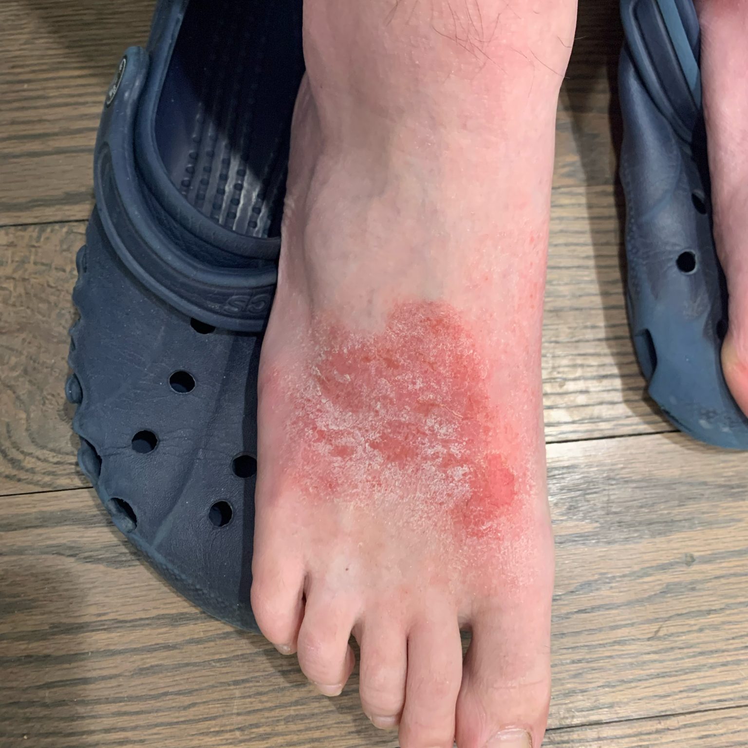 Eczema (ICD10 L20L30) Online consultation AI dermatologist