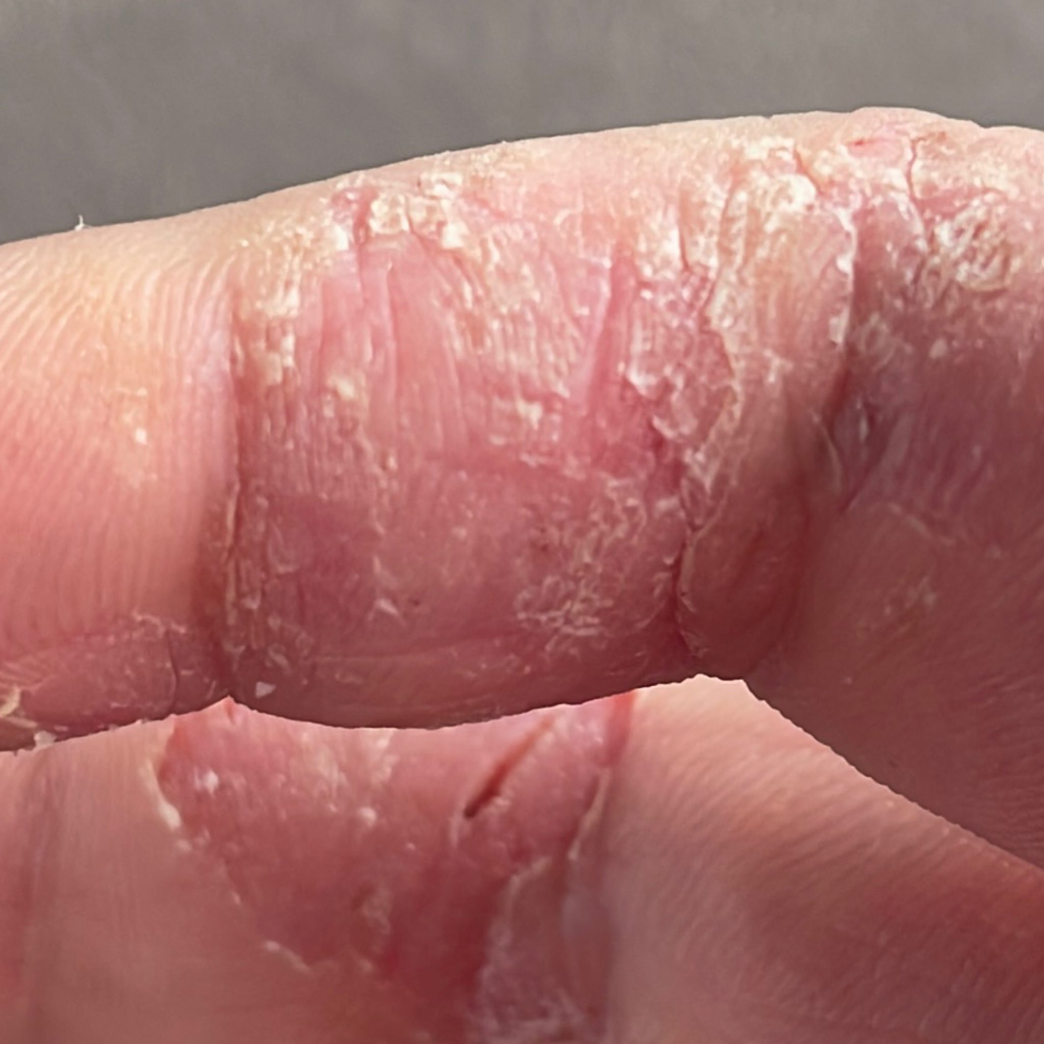 Eczema (ICD10 L20L30) Online consultation AI dermatologist