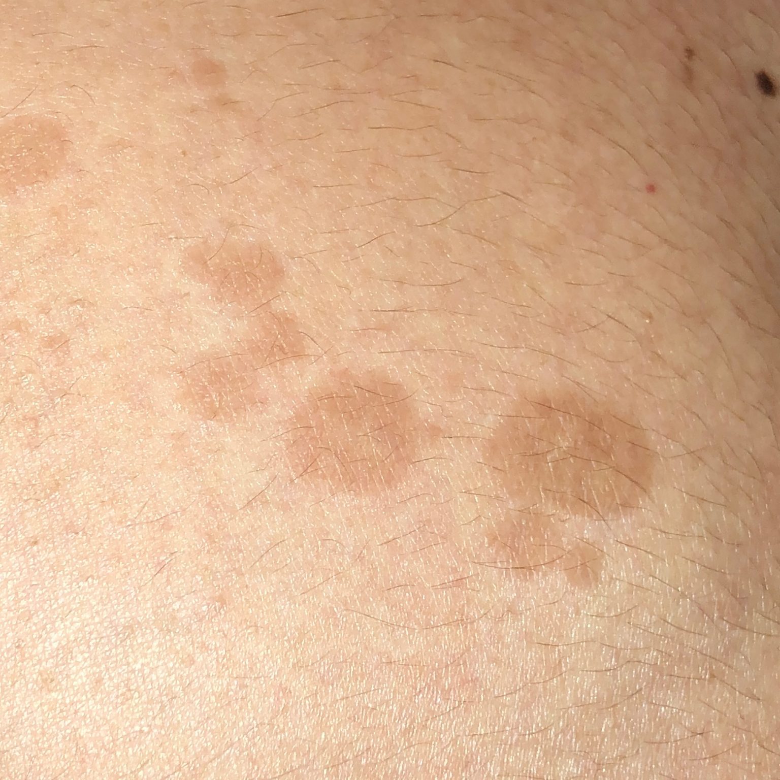 Pityriasis versicolor (ICD-10: B36.0) - Online consultation AI ...