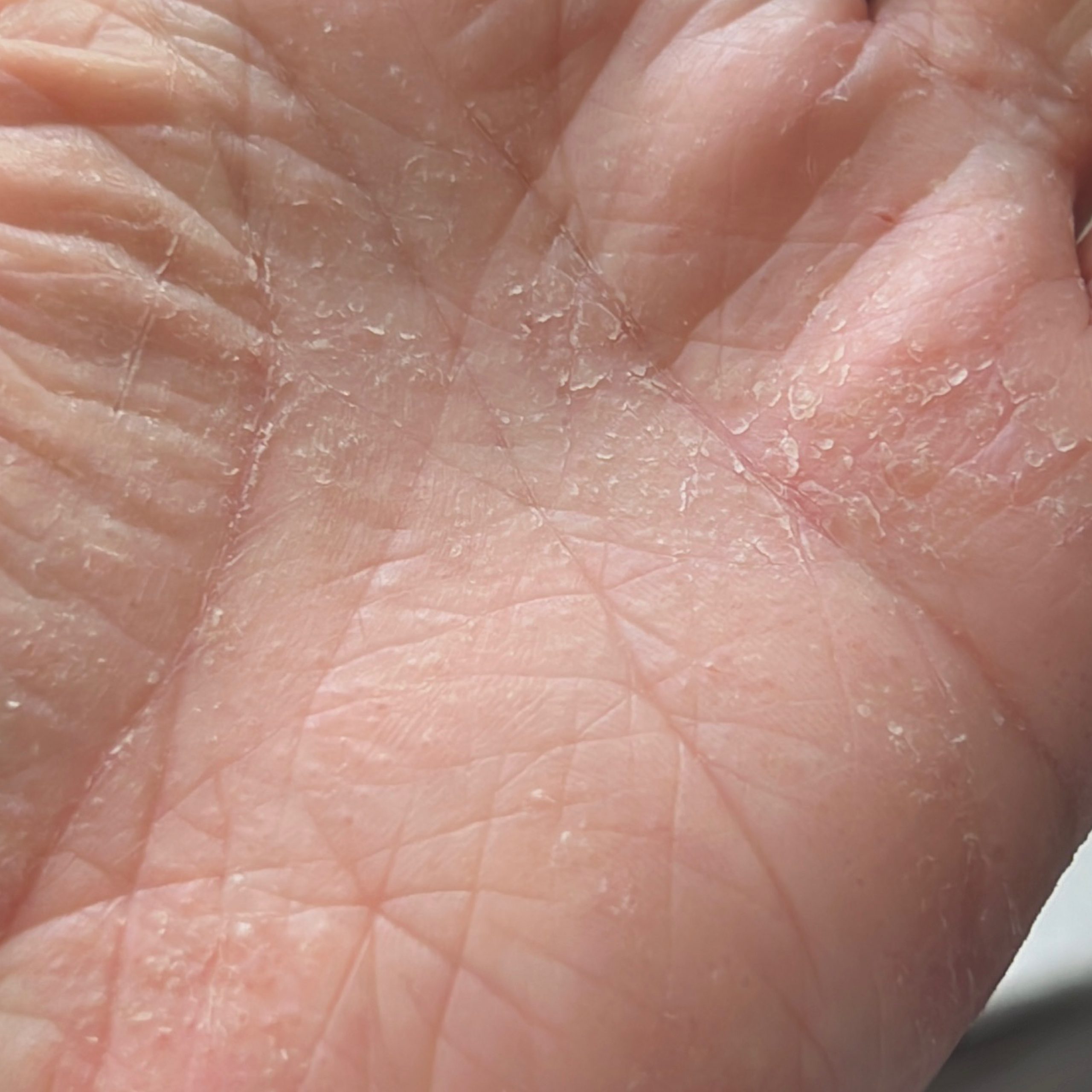 Eczema (ICD10 L20L30) Online consultation AI dermatologist